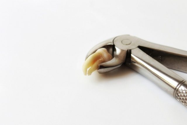 Metody usuwania zębów